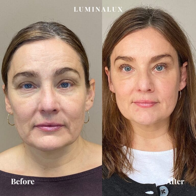 Kunden her har fået botox behandling i panden, mellem brug og ved kragetæer, hvilket har resulteret i et naturligt friskt look
