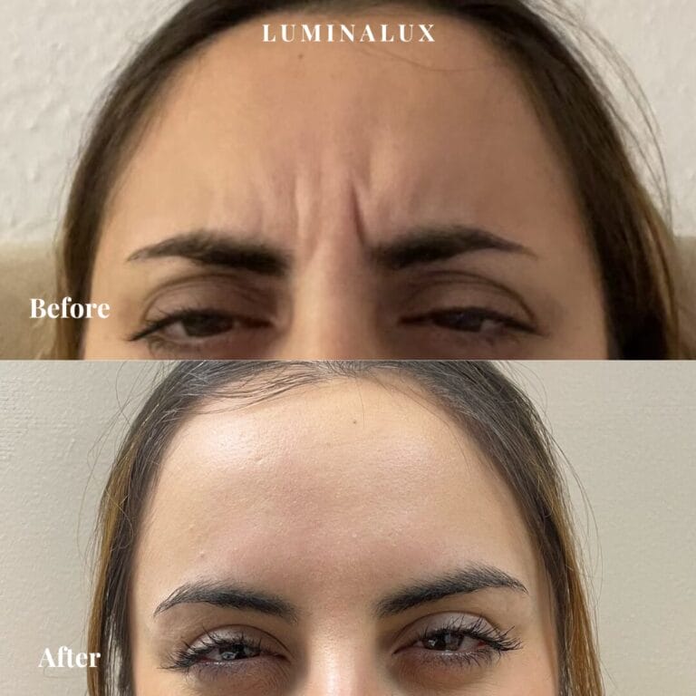 Før og efter billede af behandling med botox i bekymringsrynken (Glabella)