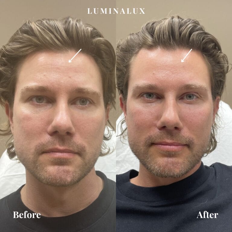 Behandling med botox i panden med fokus på et diskret resultat