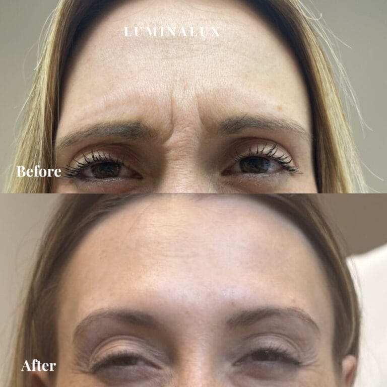 Glabella