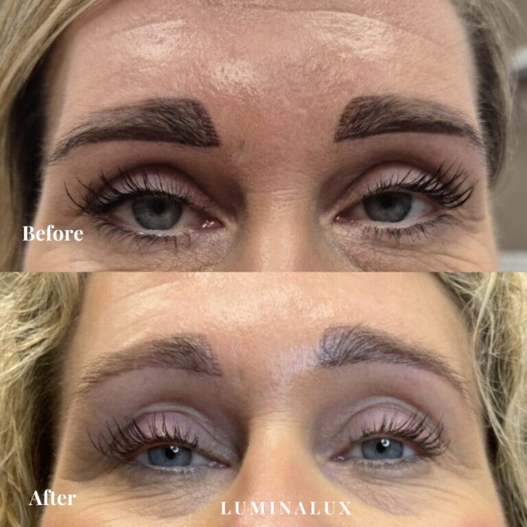 Øjenbrynsløft med botox